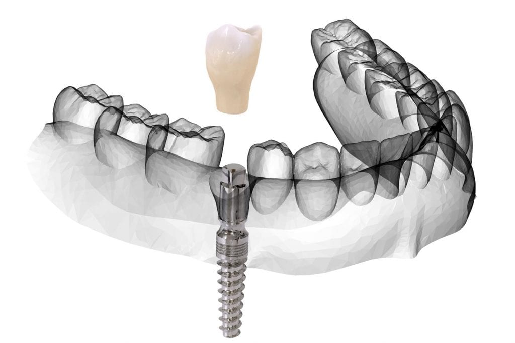How Painful Are Dental Implants