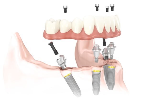 How Painful Are Dental Implants
