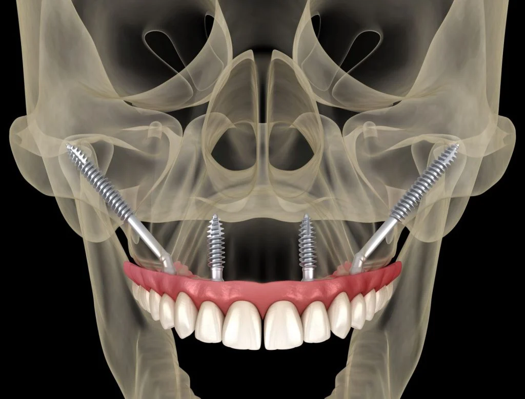 Are Dental Implants Worth It?